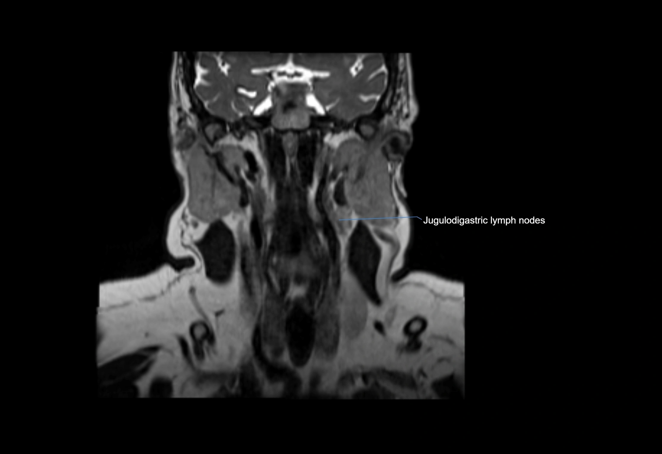 Neck coronal lymph node cross sectional MRI anatomy 3T MRI  image-img-00001-00038.webp